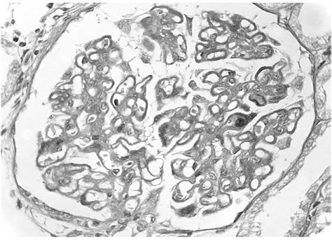 spike and dome appearance membranous nephropathy|Secondary Membranous Nephropathy. A Narrative Review .